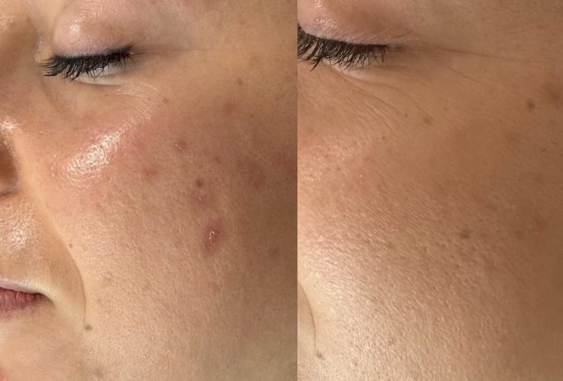 Acne & Scar Treatments