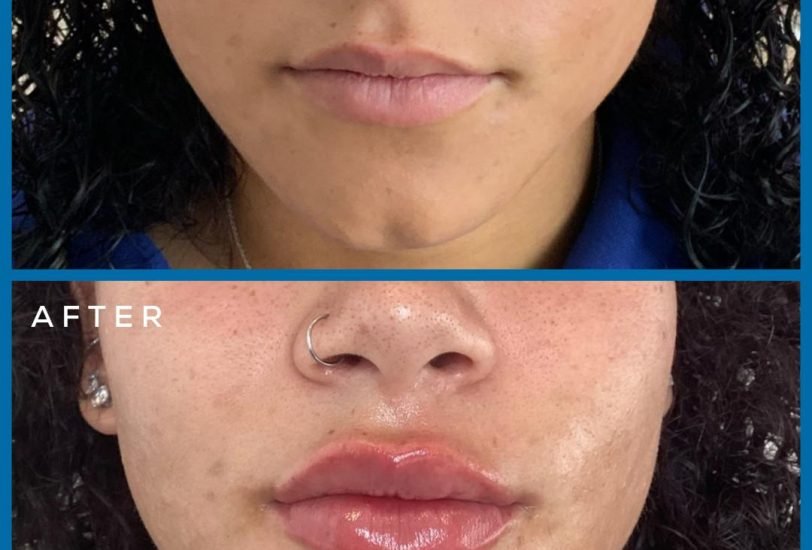 Lips Treatments