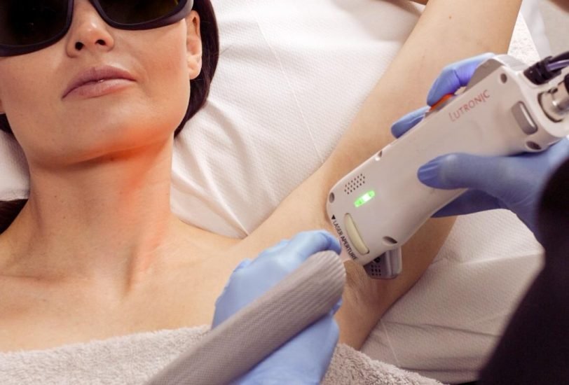 Laser Hair Removal
