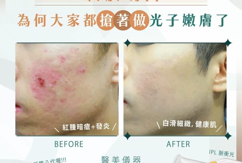 Acne & Scar Treatments
