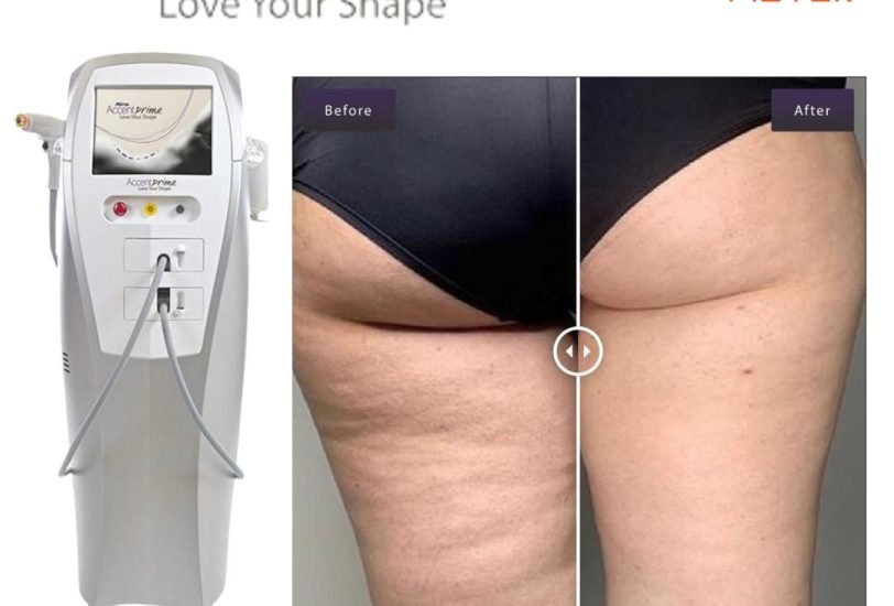Cellulite Reduction