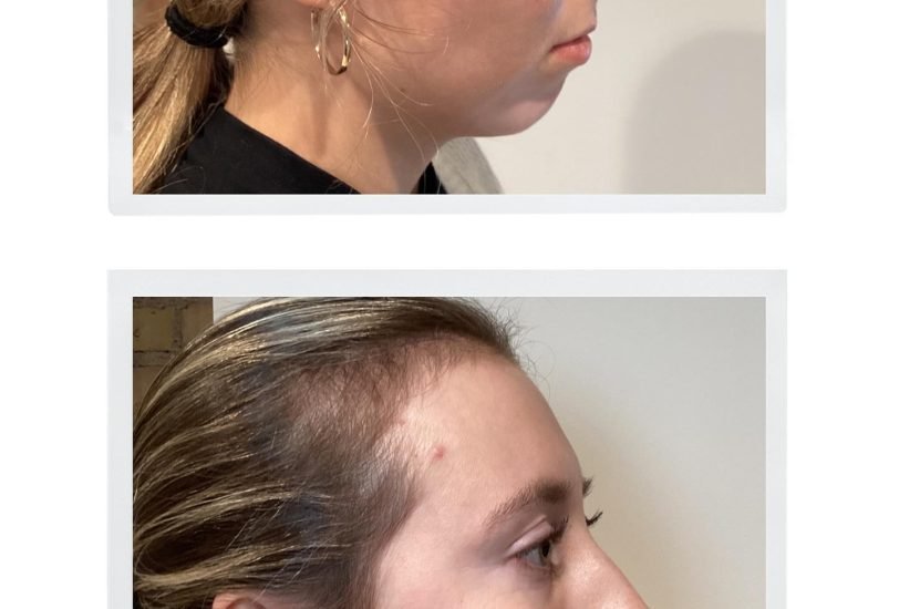 Double Chin & Jawline Contouring