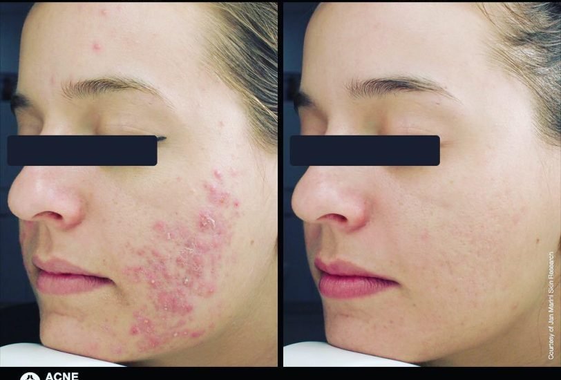 Acne & Scar Treatments