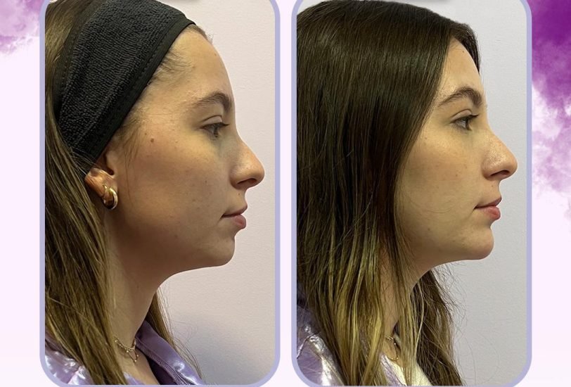 Facial Contouring & Lifting