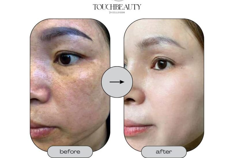 Skin Rejuvenation