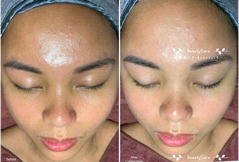 Acne & Scar Treatments
