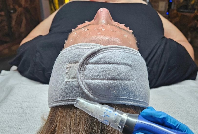 Scar Revision Treatments