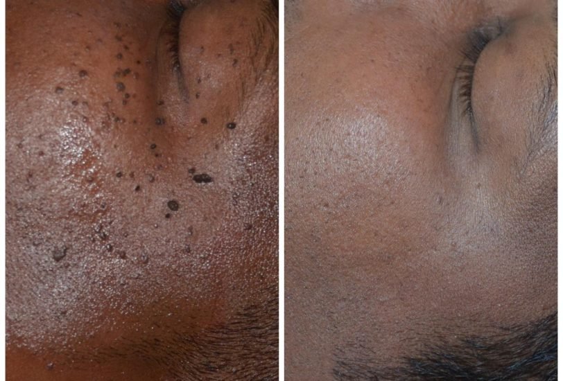 Scar Revision Treatments