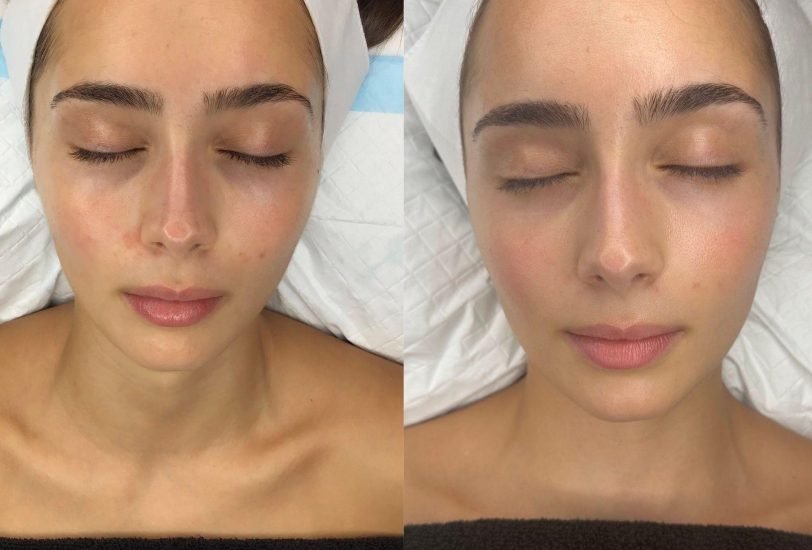 Pore & Texture Refinement