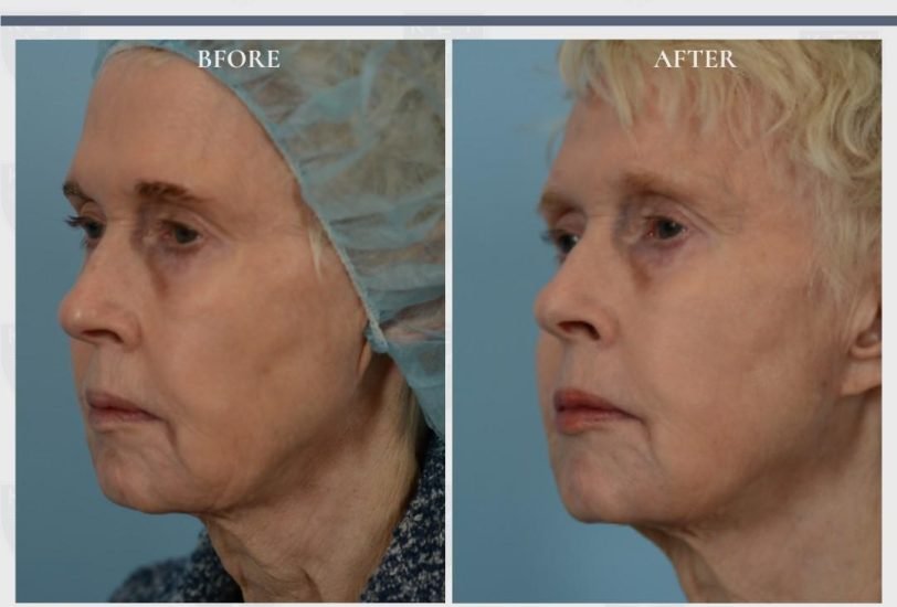 Skin Tightening