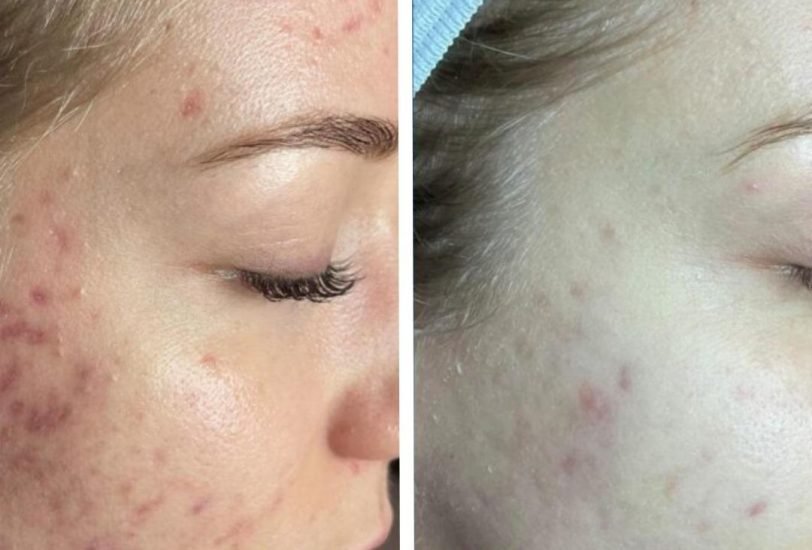 Acne & Scar Treatments