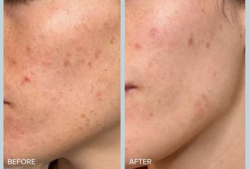 Acne & Scar Treatments