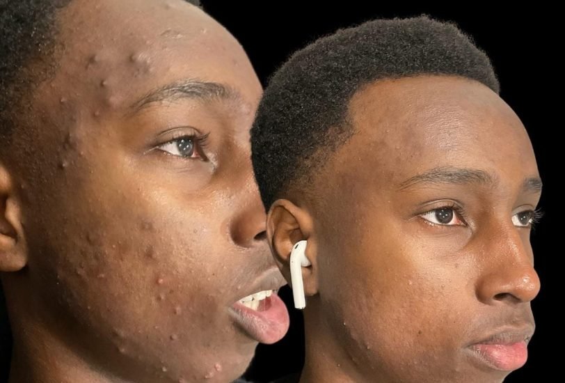 Acne & Scar Treatments