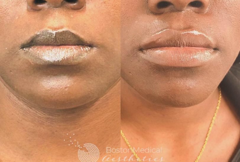 Lips Treatments