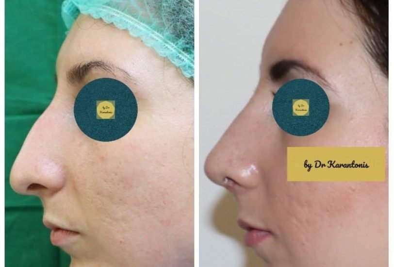 Double Chin & Jawline Contouring