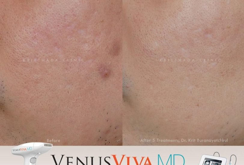 Skin Rejuvenation