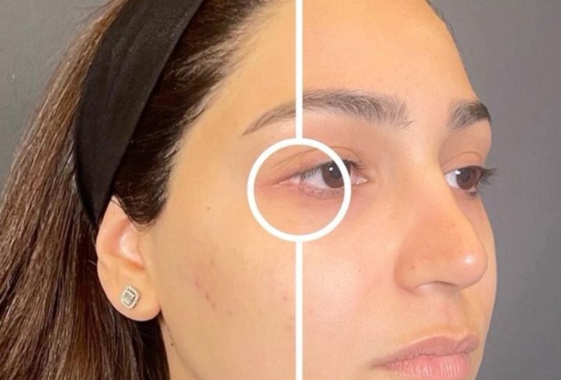 Eye Rejuvenation