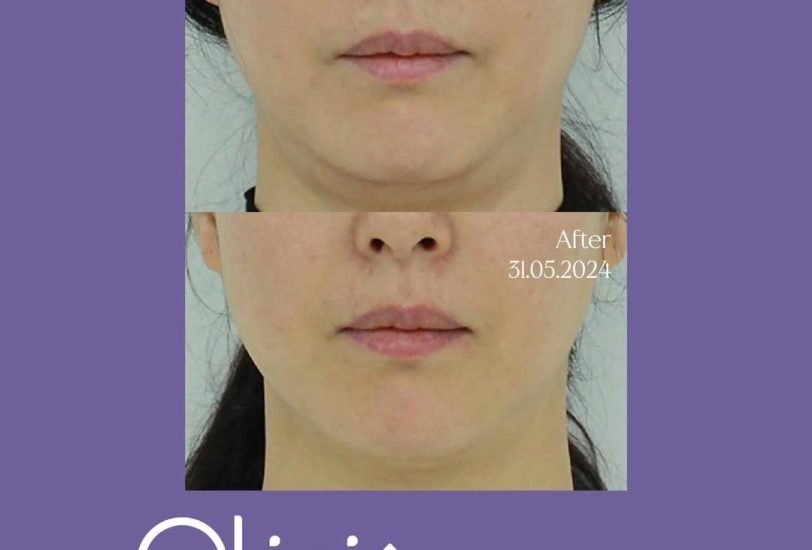 Facial Contouring & Lifting