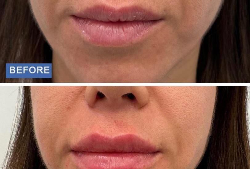 Lips Treatments