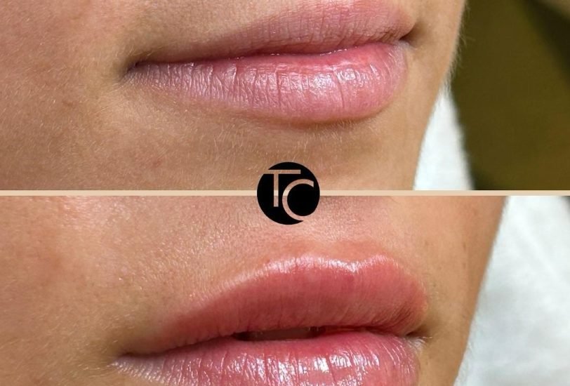 Injectable Treatments
