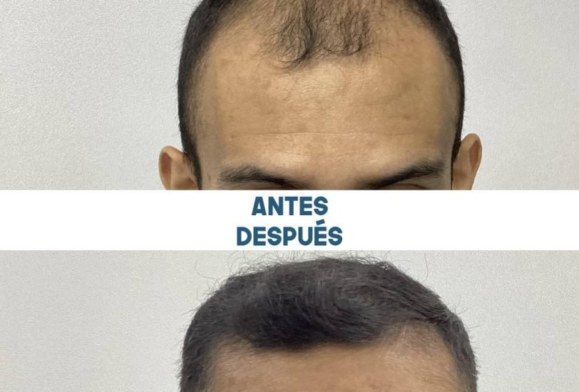Injectable Treatments