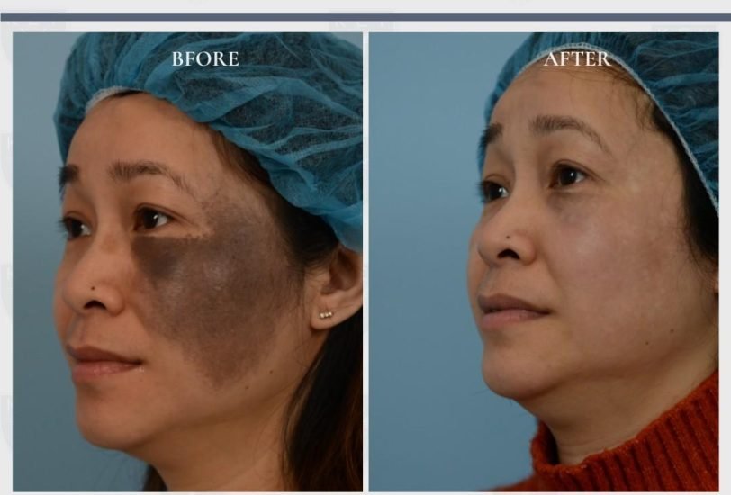 Scar Revision Treatments