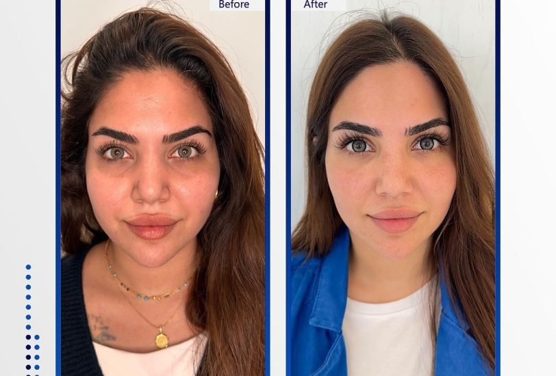 Injectable Treatments