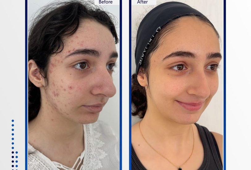 Acne & Scar Treatments