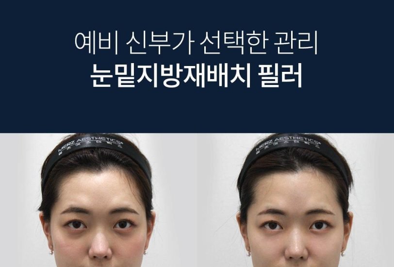 Double Chin & Jawline Contouring