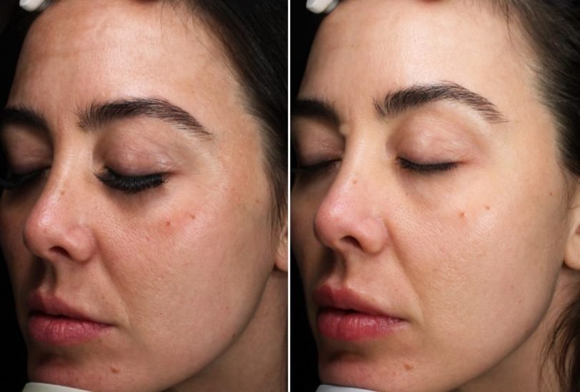 Facial Contouring & Lifting