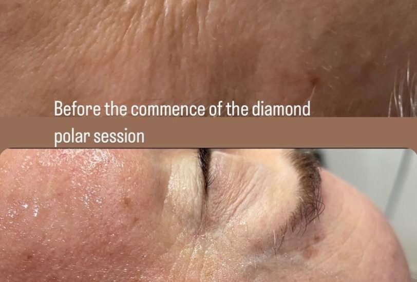 Body Peels & Exfoliation