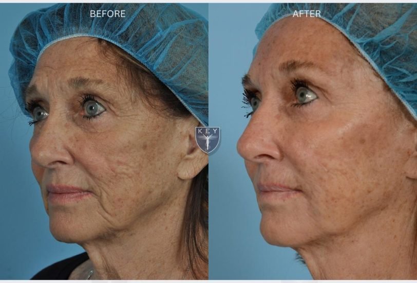 Facial Contouring & Lifting