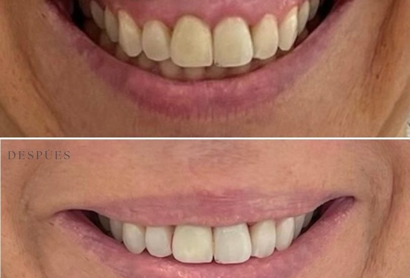Lips Treatments