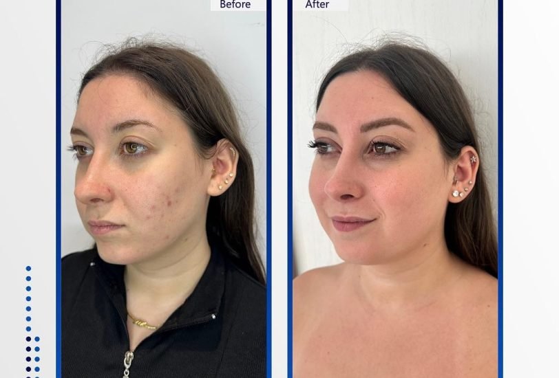Eye Rejuvenation