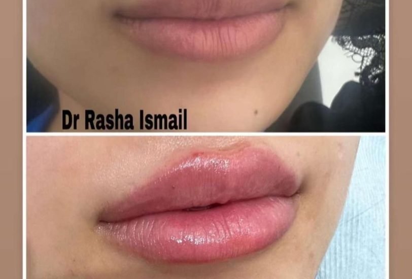 Lips Treatments