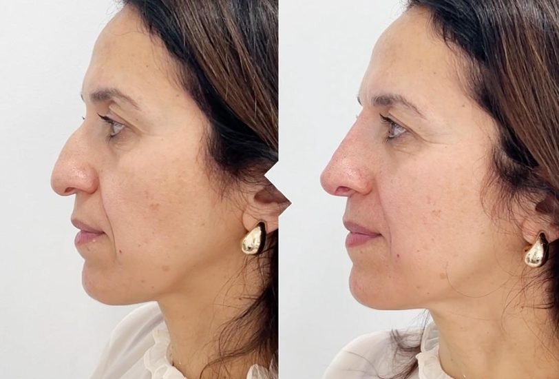 Double Chin & Jawline Contouring