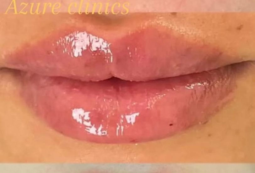 Injectable Treatments