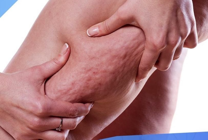 Cellulite Reduction