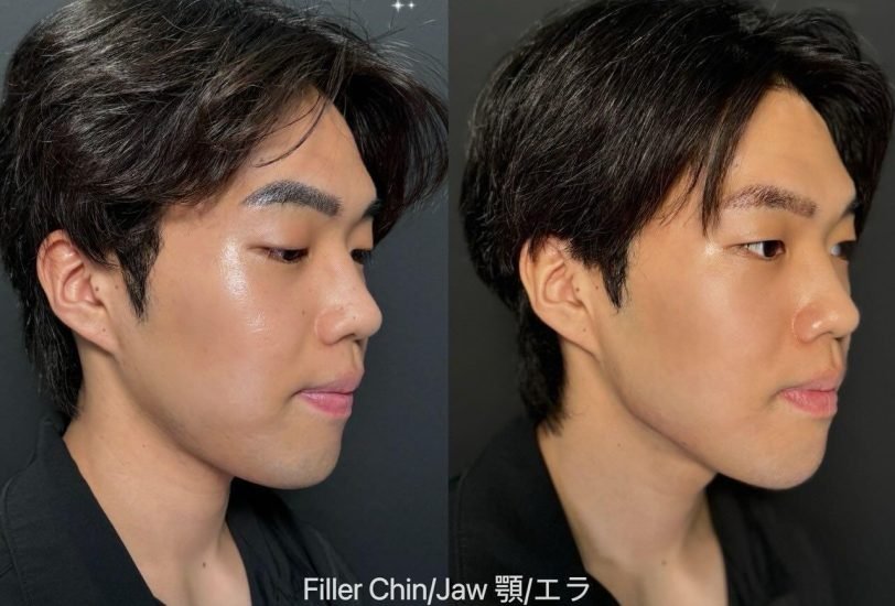 Skin Rejuvenation