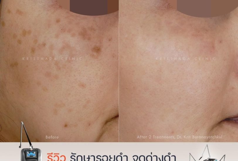Pigmentation & Skin Tone Correction