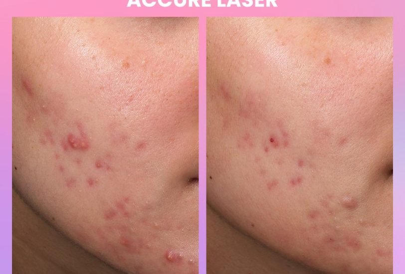 Acne & Scar Treatments