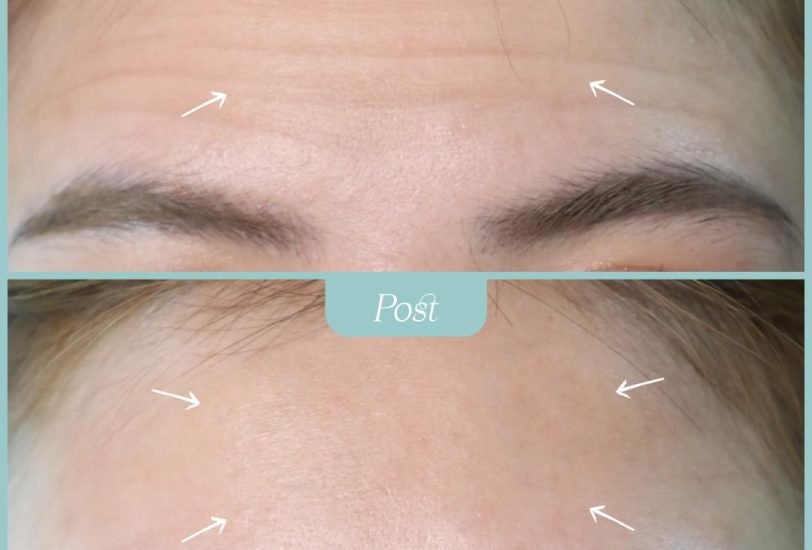 Injectable Treatments