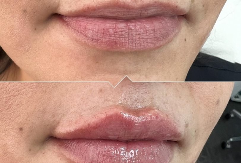 Lips Treatments