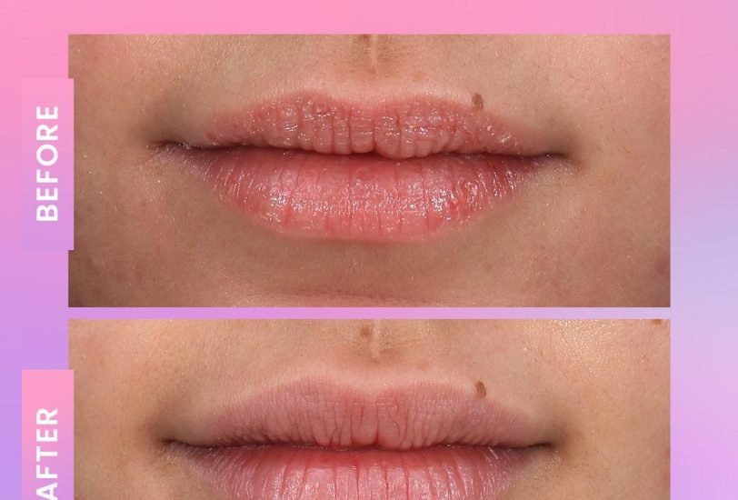 Lips Treatments