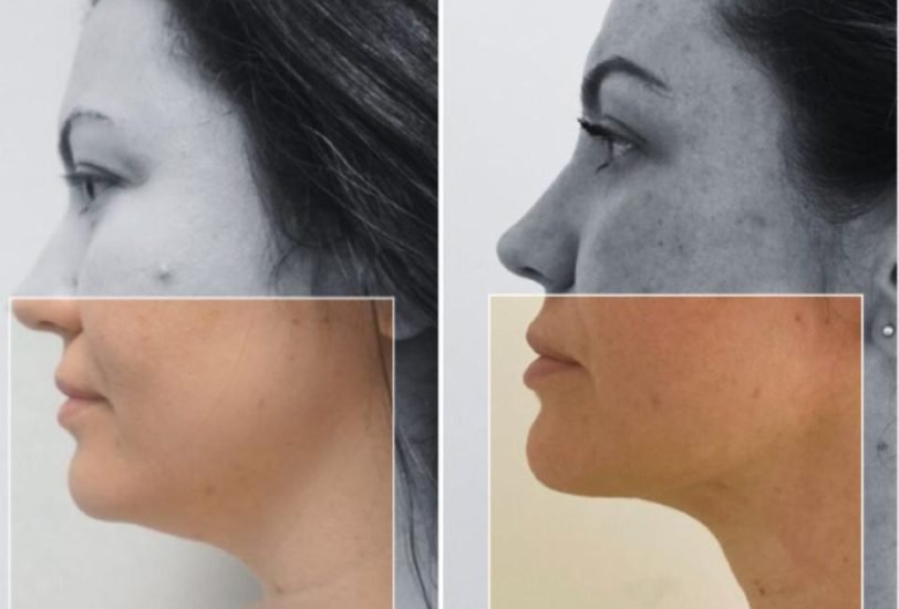 Double Chin & Jawline Contouring
