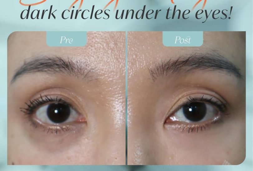Eye Rejuvenation