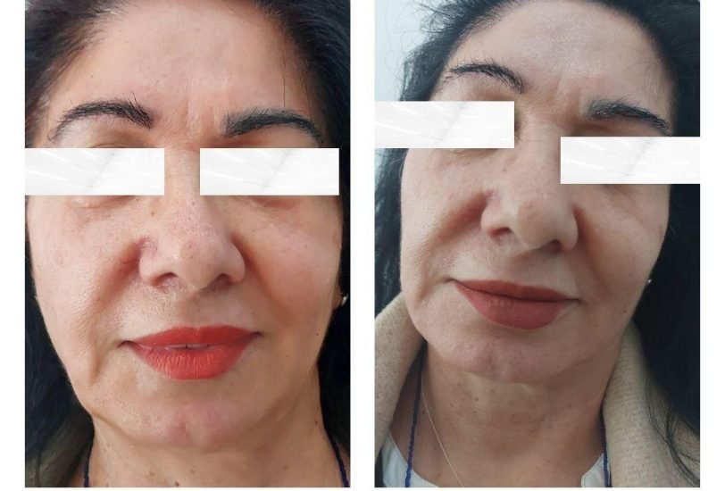 Pigmentation & Skin Tone Correction