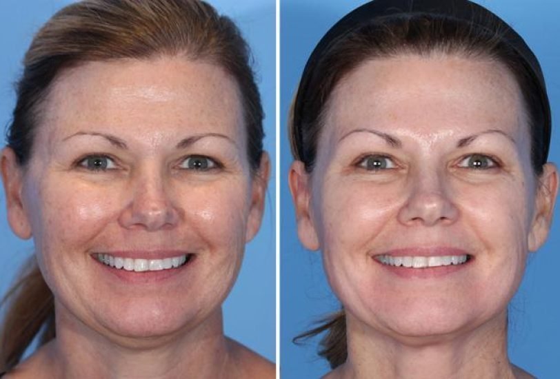 Double Chin & Jawline Contouring