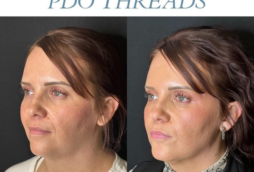 Fat Reduction Injections