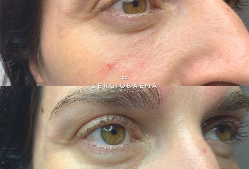 Eye Rejuvenation